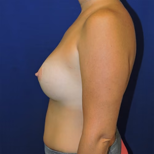Breast Augmentation before and after, case 7487 - Cool Springs Plastic Surgery