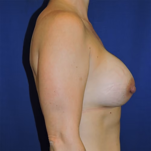 Breast Augmentation before and after, case 7566 - Cool Springs Plastic Surgery