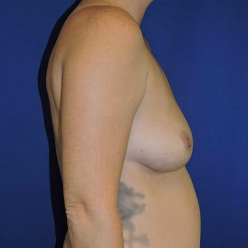 Breast Augmentation before and after, case 7609 - Cool Springs Plastic Surgery