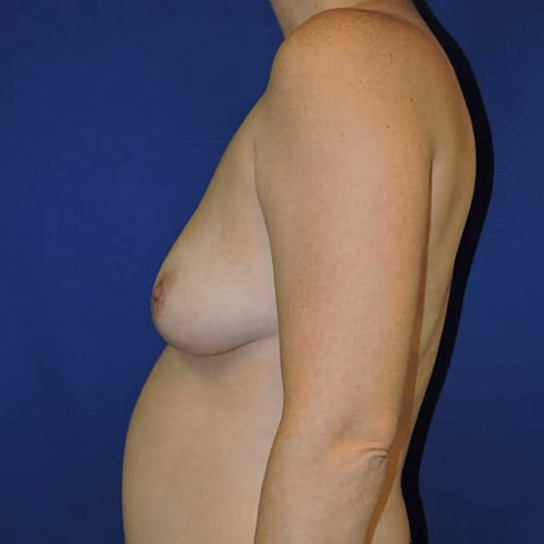 Breast Augmentation before and after, case 7609 - Cool Springs Plastic Surgery