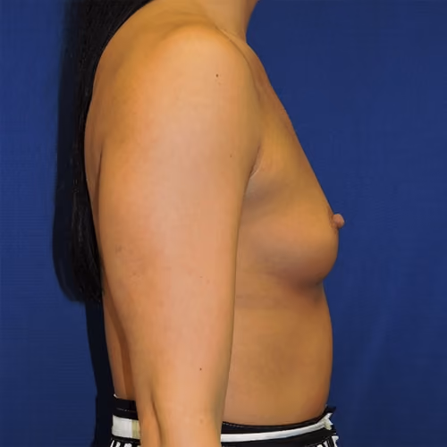 Breast Augmentation before and after, case 7644 - Cool Springs Plastic Surgery