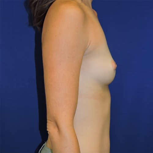 Breast Augmentation before and after, case 7710 - Cool Springs Plastic Surgery