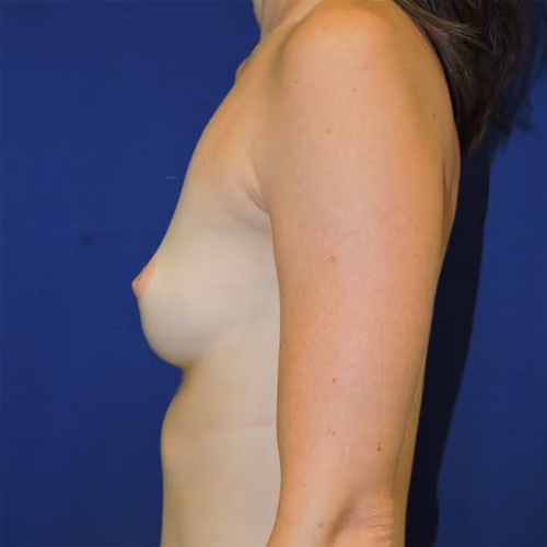Breast Augmentation before and after, case 7710 - Cool Springs Plastic Surgery