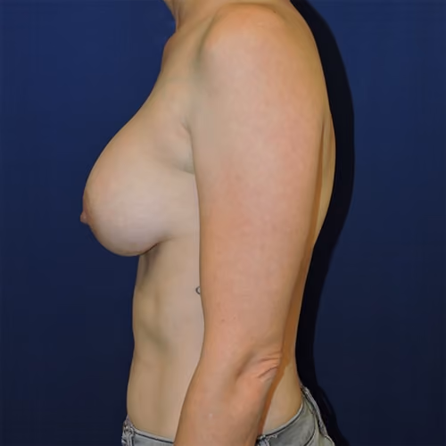 Breast Augmentation before and after, case 7741 - Cool Springs Plastic Surgery