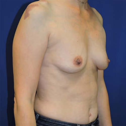 Breast Augmentation before and after, case 7741 - Cool Springs Plastic Surgery
