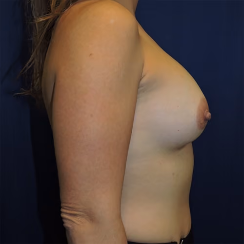Breast Augmentation before and after, case 7823 - Cool Springs Plastic Surgery