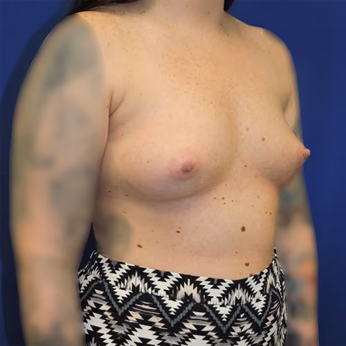Breast Augmentation before and after, case 7846 - Cool Springs Plastic Surgery