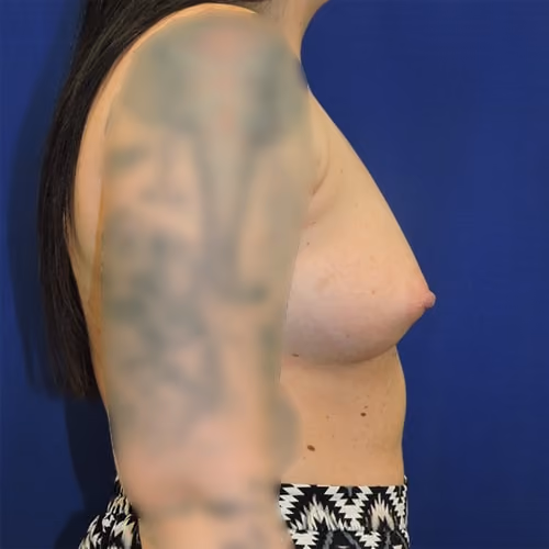 Breast Augmentation before and after, case 7846 - Cool Springs Plastic Surgery