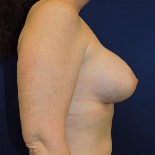 Breast Augmentation before and after, case 7903 - Cool Springs Plastic Surgery
