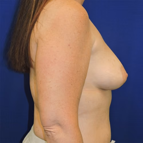 Breast Augmentation before and after, case 7903 - Cool Springs Plastic Surgery