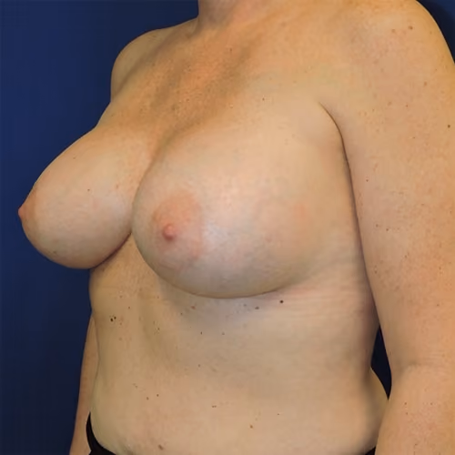 Breast Augmentation before and after, case 7903 - Cool Springs Plastic Surgery