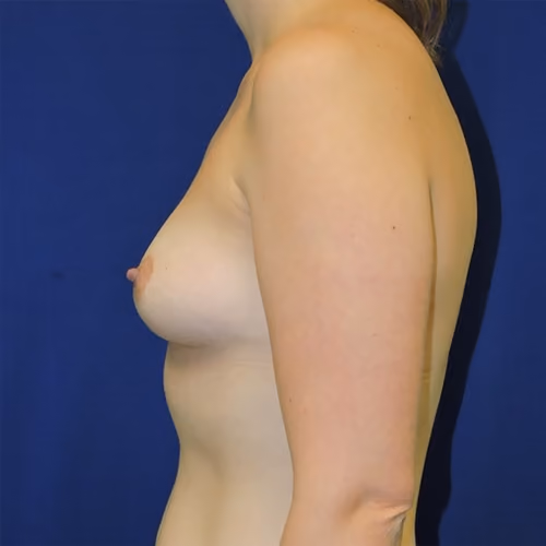 Breast Augmentation before and after, case 7955 - Cool Springs Plastic Surgery