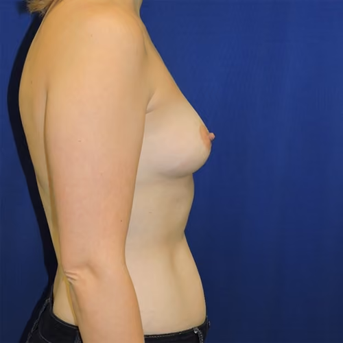 Breast Augmentation before and after, case 7955 - Cool Springs Plastic Surgery