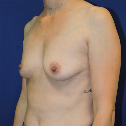 Breast Augmentation before and after, case 8000 - Cool Springs Plastic Surgery