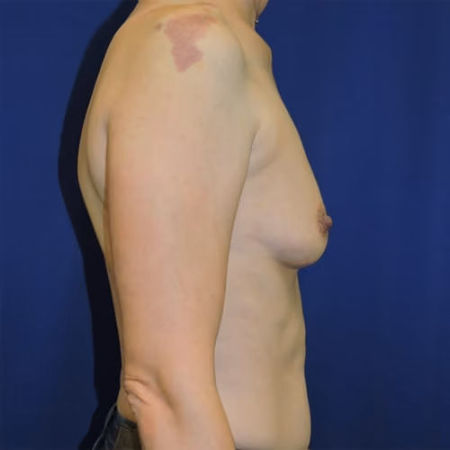 Breast Augmentation before and after, case 8000 - Cool Springs Plastic Surgery