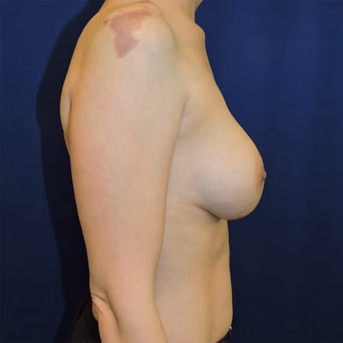 Breast Augmentation before and after, case 8000 - Cool Springs Plastic Surgery
