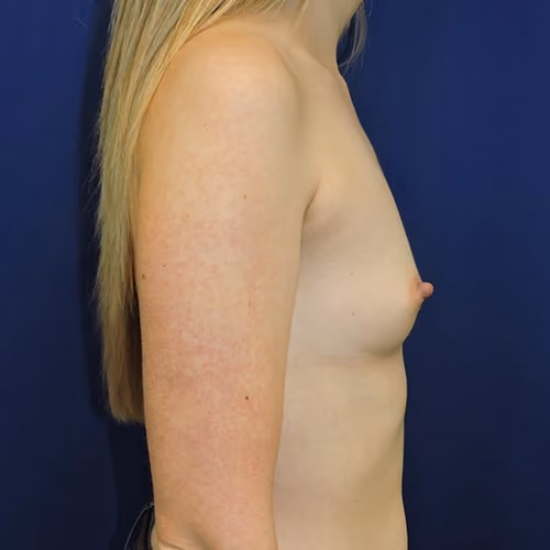 Breast Augmentation before and after, case 8045 - Cool Springs Plastic Surgery