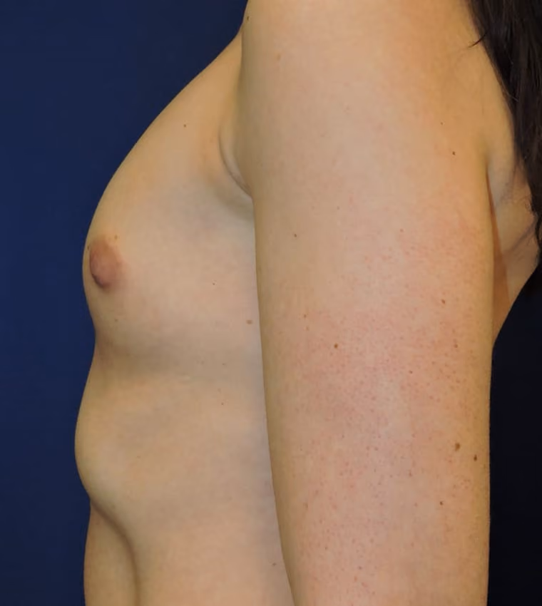 Breast Augmentation before and after, case 8512 - Cool Springs Plastic Surgery