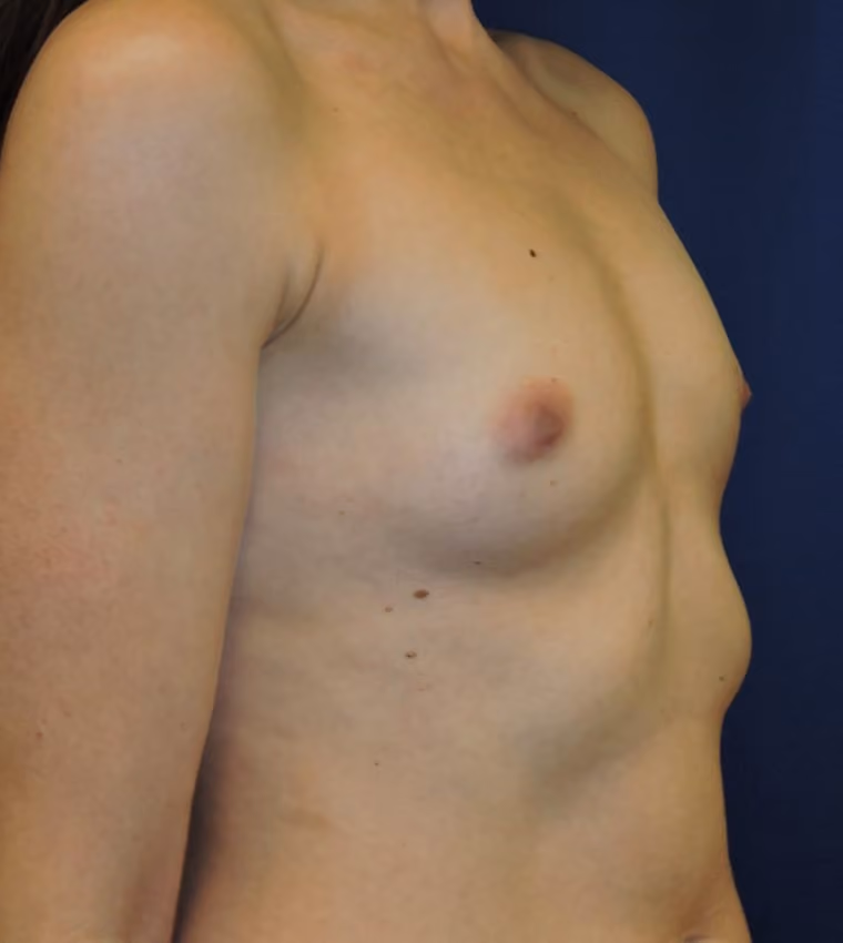 Breast Augmentation before and after, case 8512 - Cool Springs Plastic Surgery