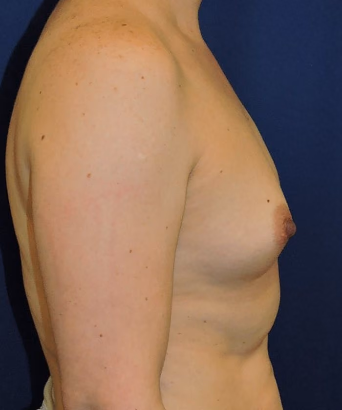 Breast Augmentation before and after, case 8684 - Cool Springs Plastic Surgery