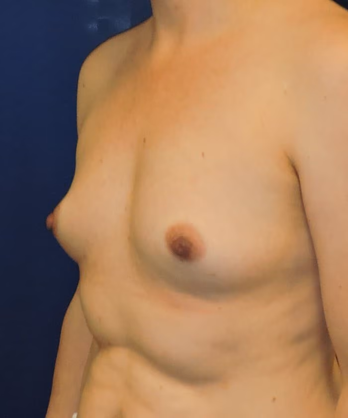 Breast Augmentation before and after, case 8684 - Cool Springs Plastic Surgery