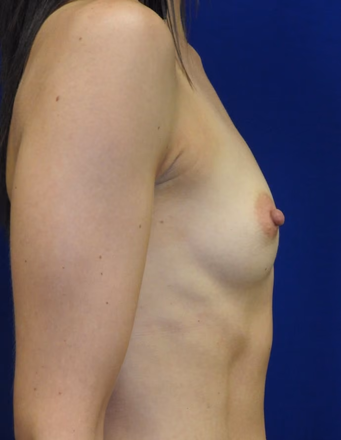 Breast Augmentation before and after, case 8719 - Cool Springs Plastic Surgery