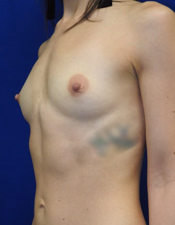 Breast Augmentation before and after, case 8719 - Cool Springs Plastic Surgery