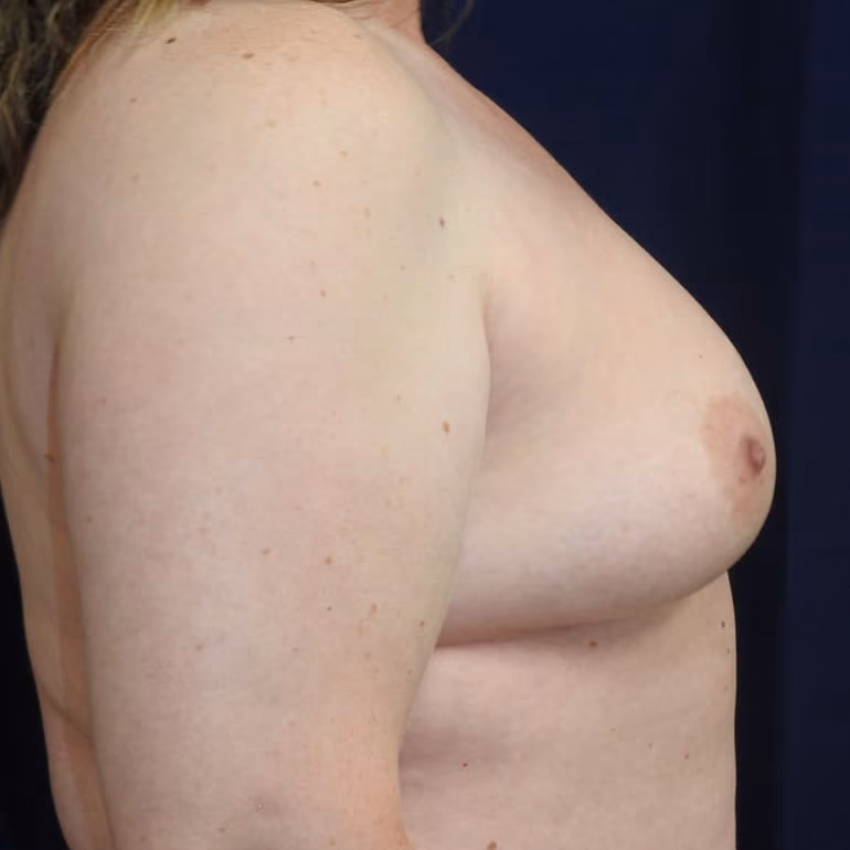 Breast Augmentation before and after, case 8736 - Cool Springs Plastic Surgery