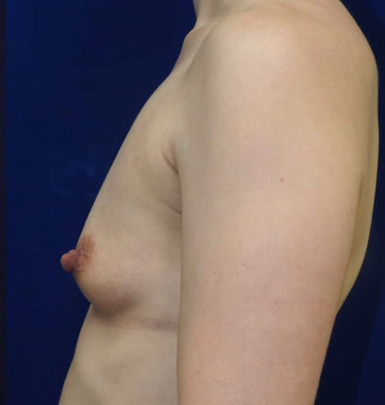 Breast Augmentation before and after, case 8886 - Cool Springs Plastic Surgery