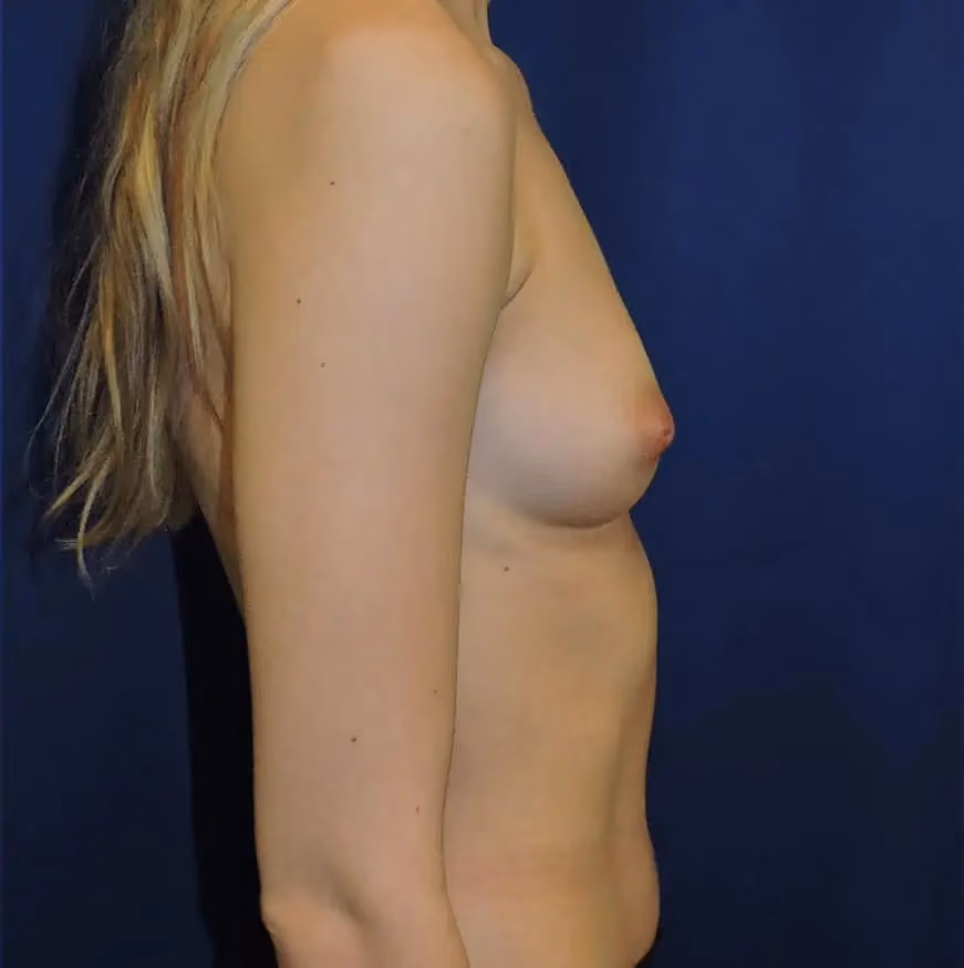 Breast Augmentation before and after, case 10760 - Cool Springs Plastic Surgery