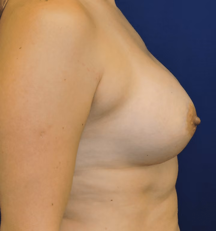 Breast Augmentation before and after, case 8916 - Cool Springs Plastic Surgery