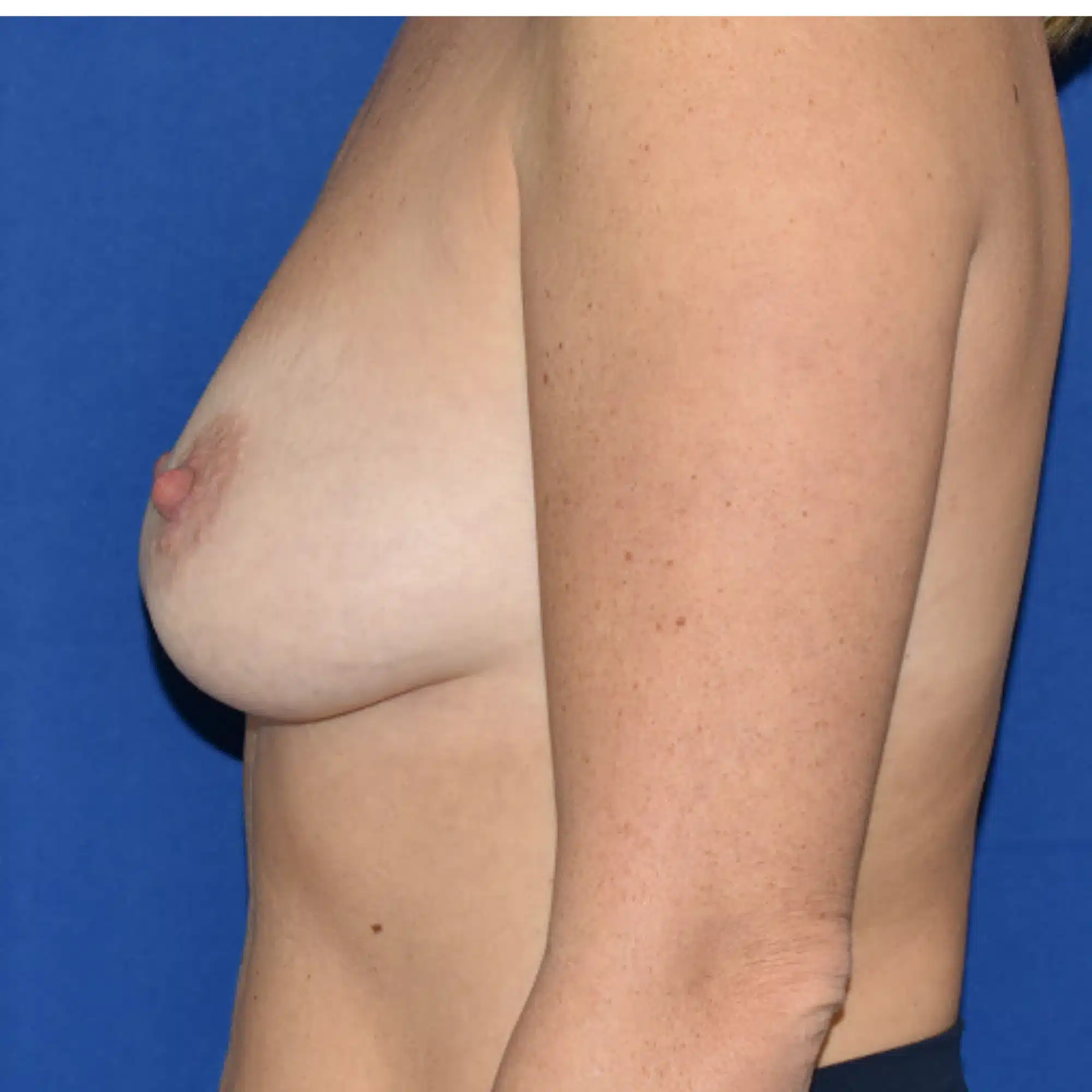 Breast Augmentation before and after, Dr. Sarosiek, case 13794 - Cool Springs Plastic Surgery