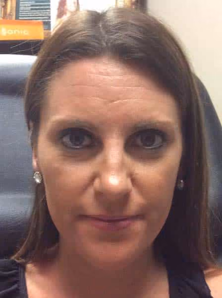 Botox before and after, case 2000 - Cool Springs Plastic Surgery