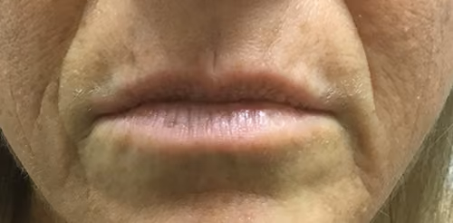 Botox before and after, case 8874 - Cool Springs Plastic Surgery