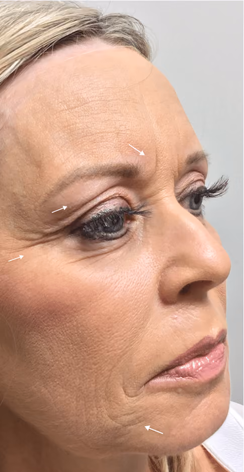Botox before and after, Chrissy Handly, case 9574 - Cool Springs Plastic Surgery