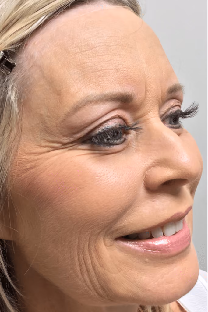 Botox before and after, Chrissy Handly, case 9574 - Cool Springs Plastic Surgery