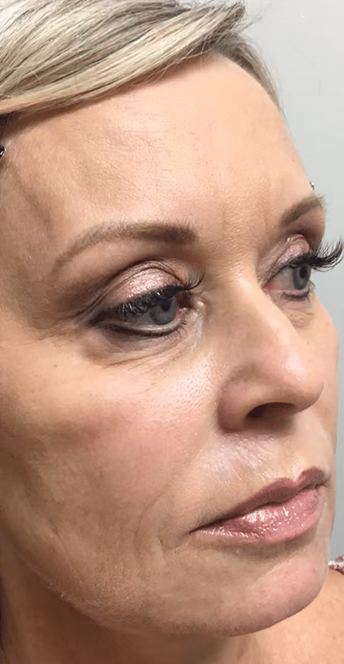 Botox before and after, Chrissy Handly, case 9574 - Cool Springs Plastic Surgery
