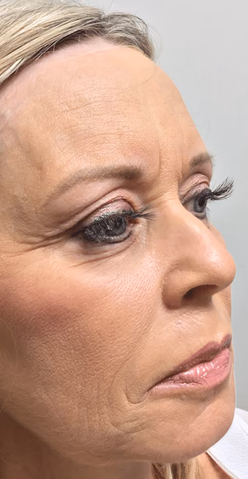 Botox before and after, Chrissy Handly, case 9574 - Cool Springs Plastic Surgery