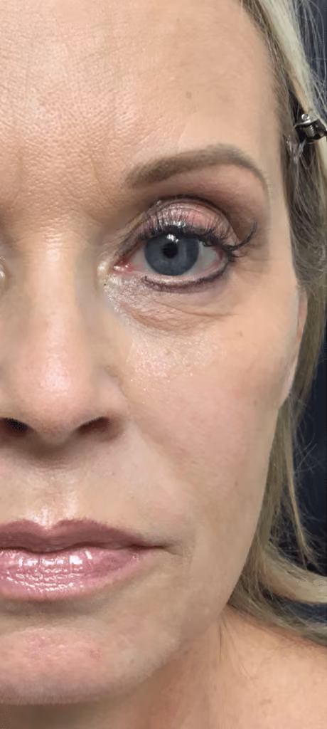 Botox before and after, Chrissy Handly, case 9574 - Cool Springs Plastic Surgery