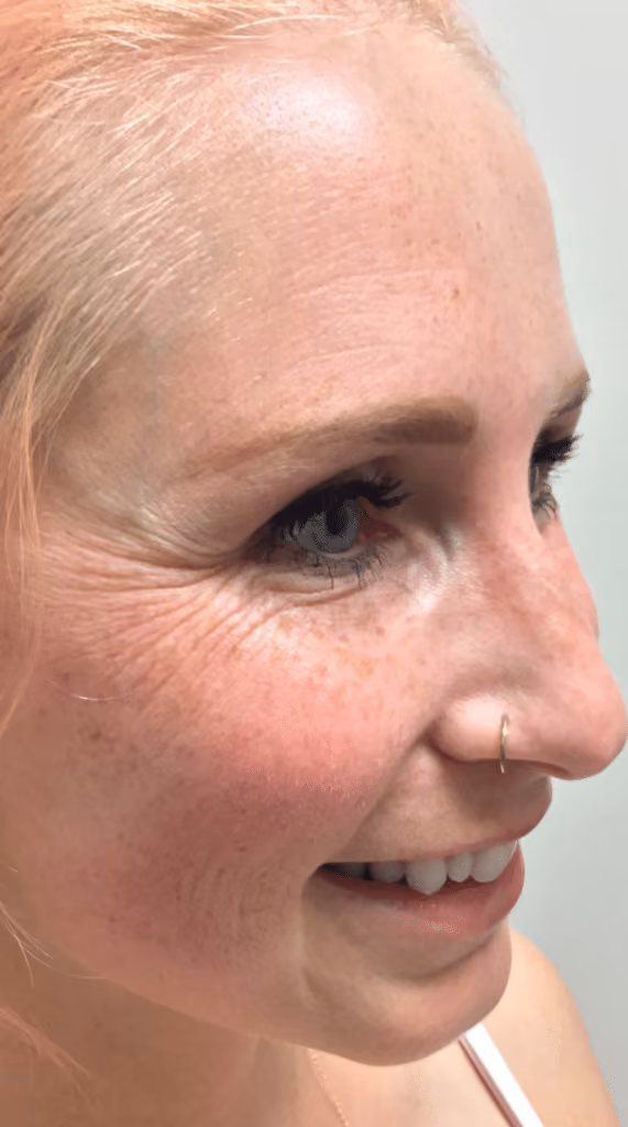 Botox before and after, Olivia Salmen, case 9588 - Cool Springs Plastic Surgery