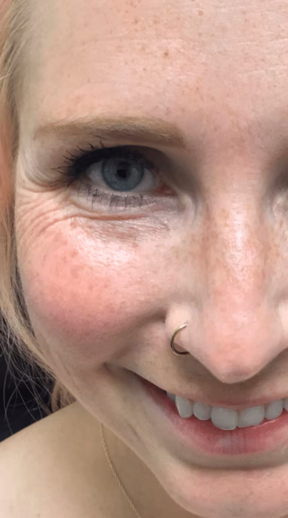 Botox before and after, Olivia Salmen, case 9588 - Cool Springs Plastic Surgery