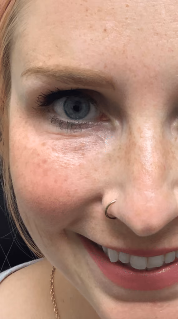 Botox before and after, Olivia Salmen, case 9588 - Cool Springs Plastic Surgery