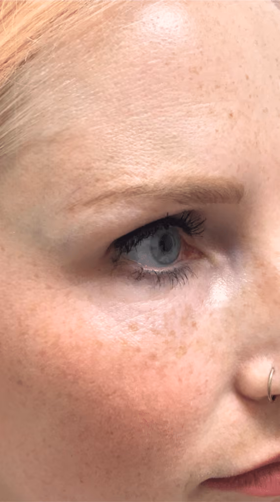 Botox before and after, Olivia Salmen, case 9588 - Cool Springs Plastic Surgery