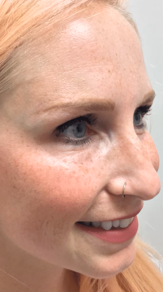 Botox before and after, Olivia Salmen, case 9588 - Cool Springs Plastic Surgery
