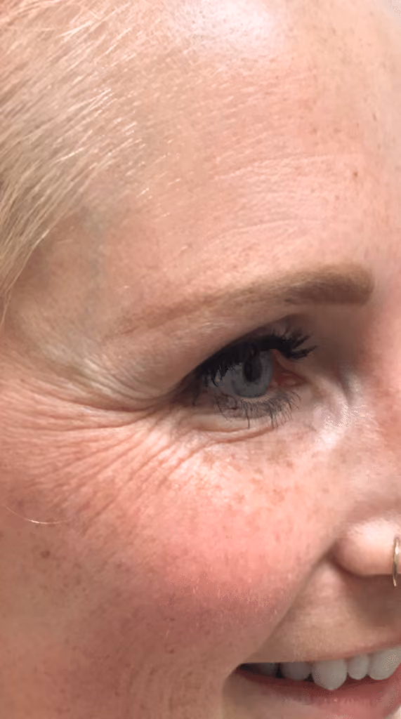 Botox before and after, Olivia Salmen, case 9588 - Cool Springs Plastic Surgery