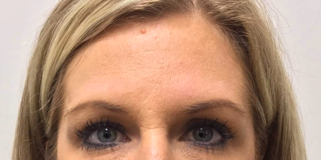 Botox before and after, Olivia Salmen, case 9730 - Cool Springs Plastic Surgery