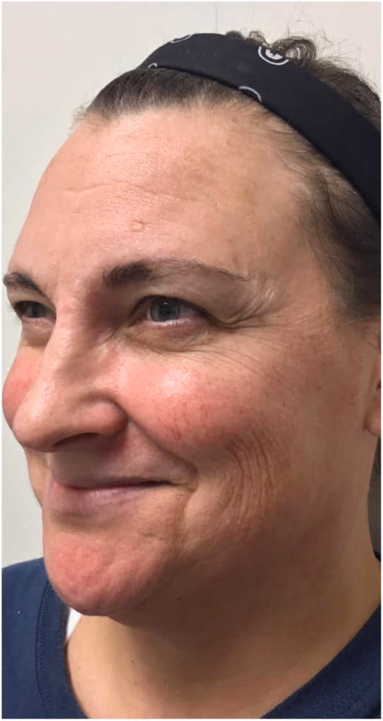 Botox before and after, Olivia Salmen, case 9736 - Cool Springs Plastic Surgery