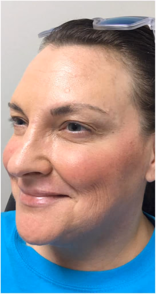 Botox before and after, Olivia Salmen, case 9736 - Cool Springs Plastic Surgery