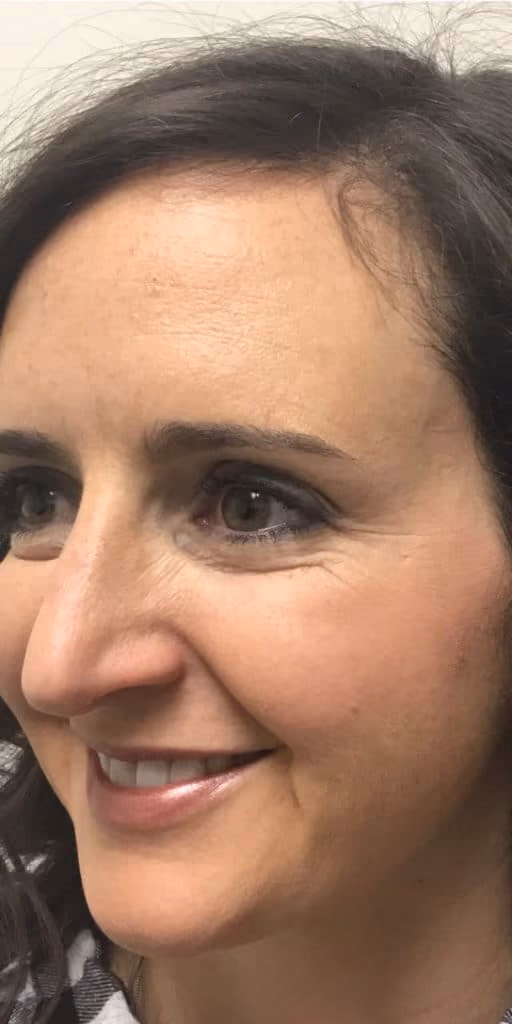 Botox before and after, Olivia Salmen, case 9740 - Cool Springs Plastic Surgery