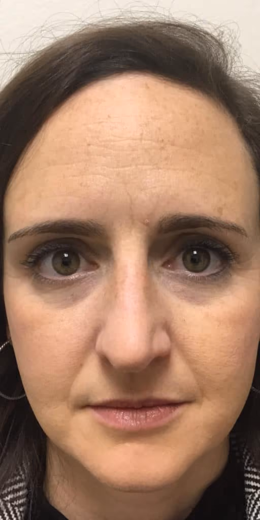 Botox before and after, Olivia Salmen, case 9740 - Cool Springs Plastic Surgery